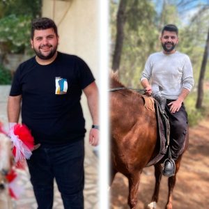 Gastric Sleeve Surgery